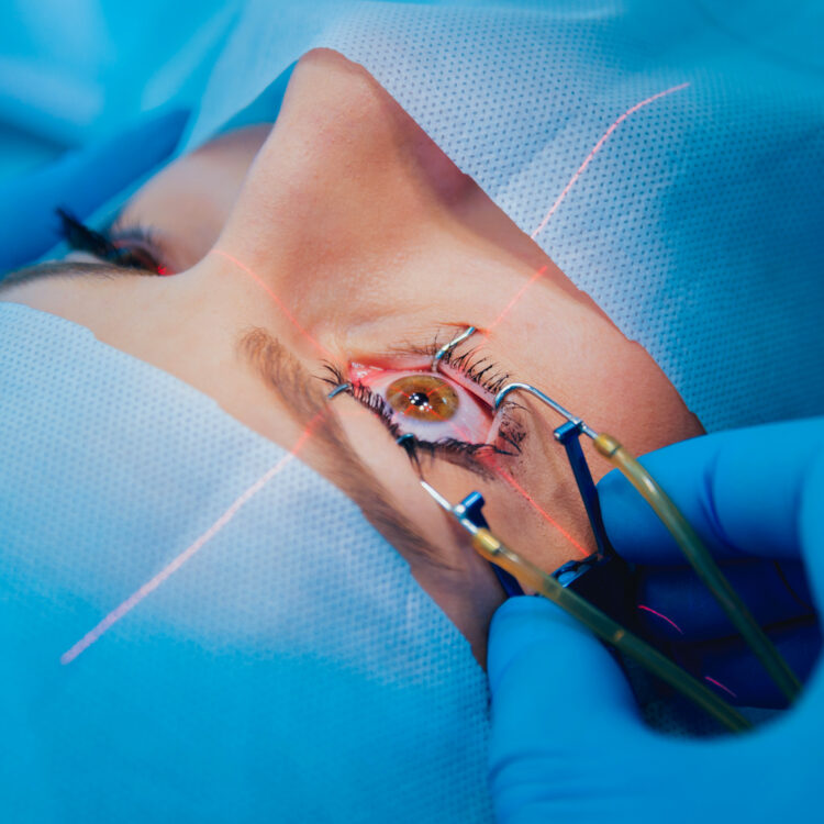 Photorefractive Keratectomy (PRK)