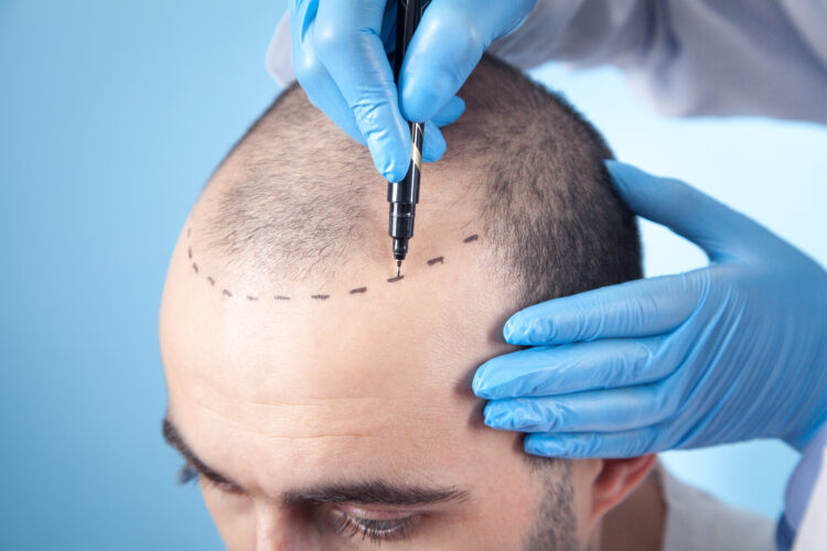 Sapphire Hair Transplant